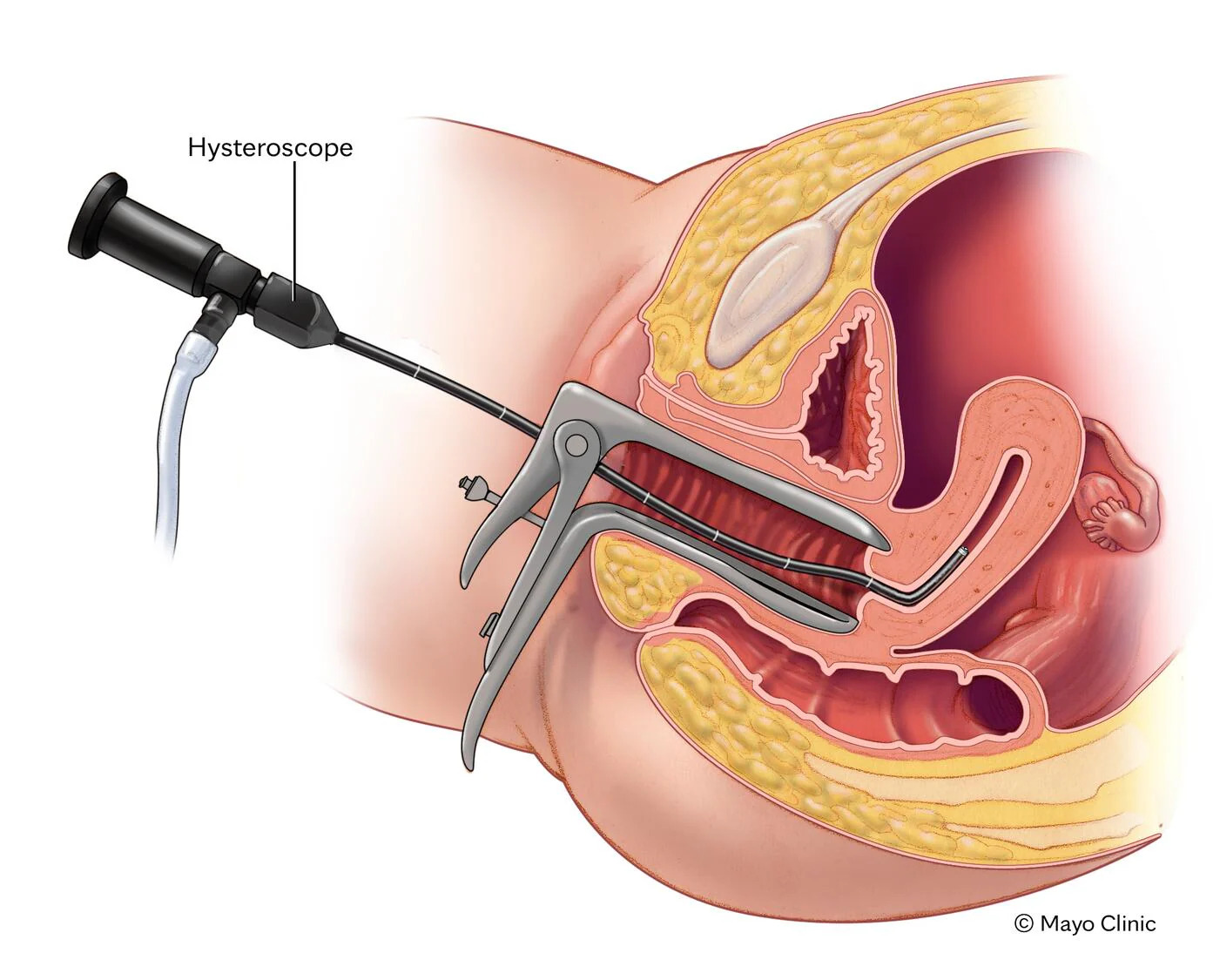 Duckbill Hysteroscopic Polyp Snare, 1 Each