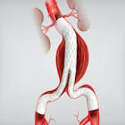 Zenith Flex With Spiral-z Technology Aaa Endovascular Graft Iliac Leg, 1 Each