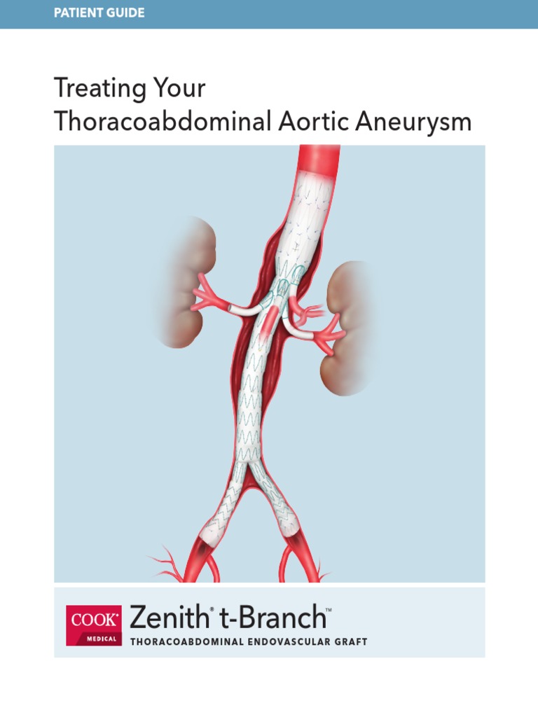 Zenith T-branch Thoracoabdominal Endovascular Graft, 1 Each