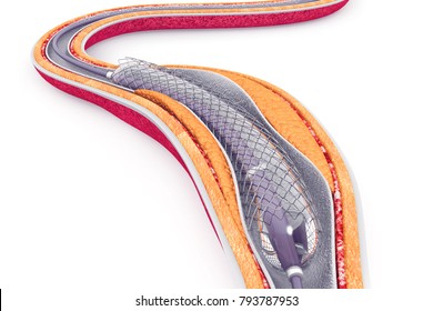 Formula 535 Vascular Balloon-expandable Stent, 1 Each