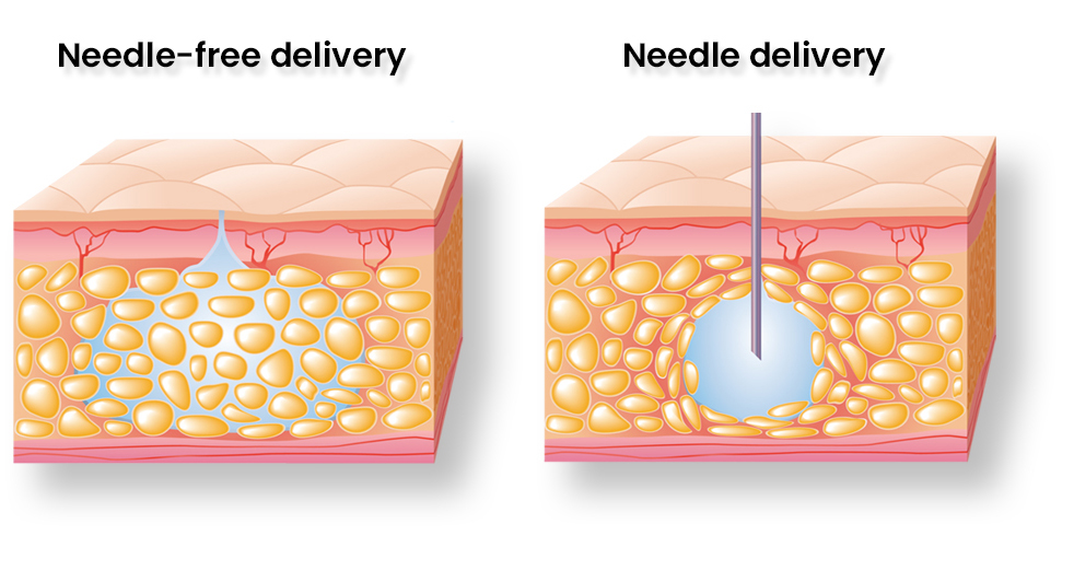 Peel-away Sheath Needle, 1 Each