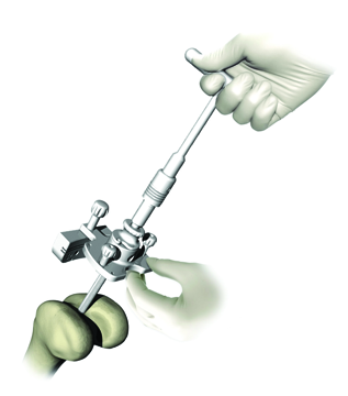 Femoral Drill Guide