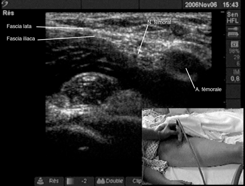 Femoral Cutting Block