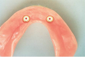 HOLDER X43506211 IMPLANT LATERAL