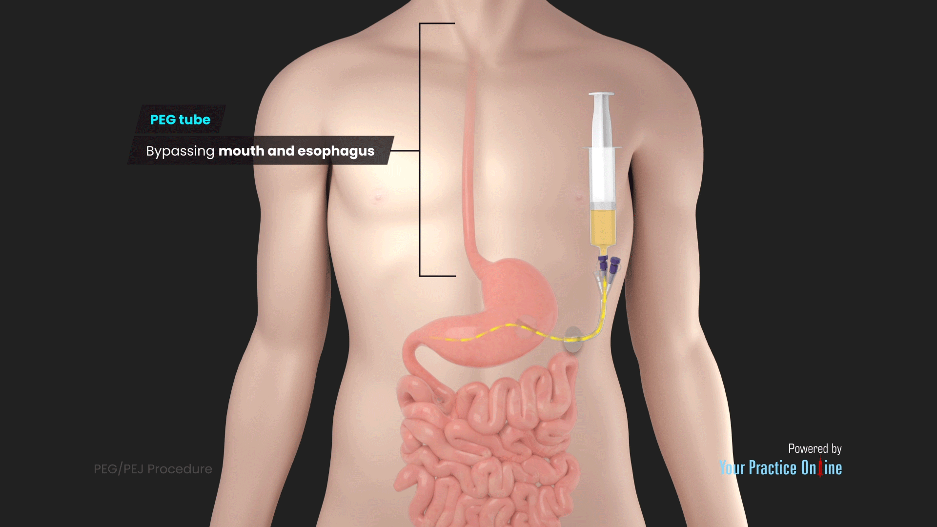 Ultrathane Wills-oglesby Single Lumen Percutaneous Gastrostomy Set, 1 Set