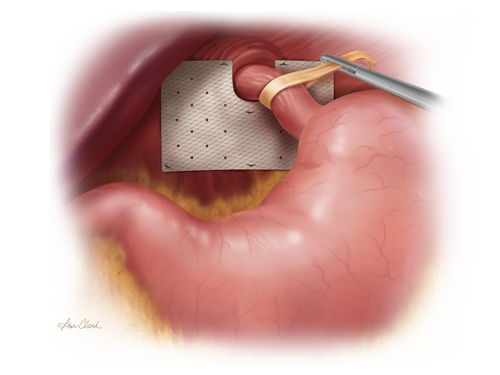 Biodesign Hiatal Hernia Graft, 1 Each