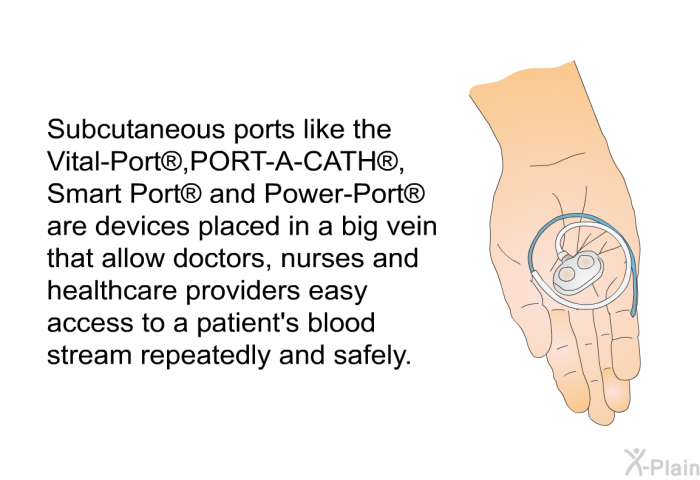 Vital-port Detached Silicone Catheter With Int Titanium Power Injectable Port, 1 Each